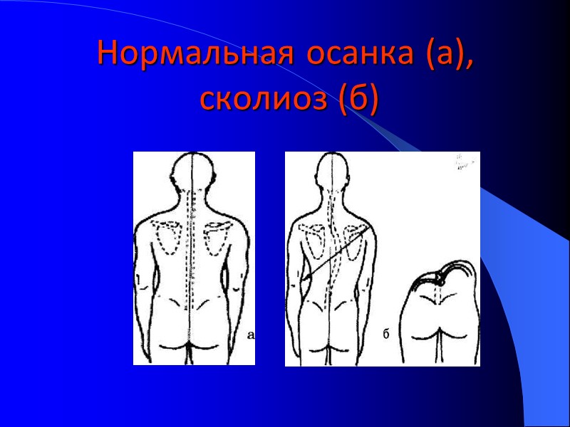 Нормальная осанка (а),  сколиоз (б)